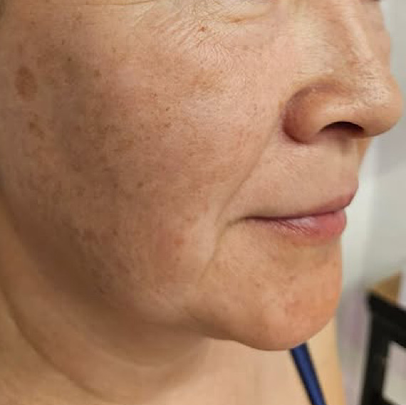 До процедуры