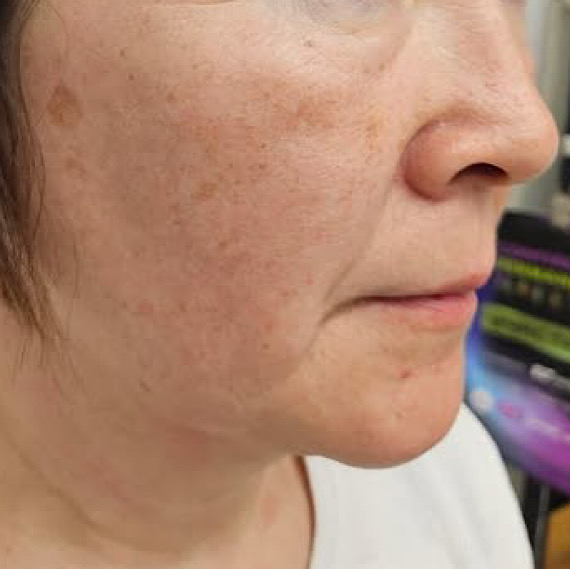 После процедуры