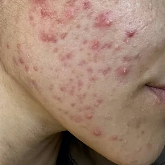 До процедуры