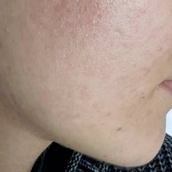 После процедуры