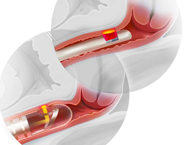 Интимное лазерное омоложение