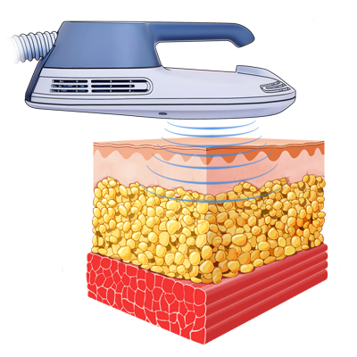 Проведение процедуры.
