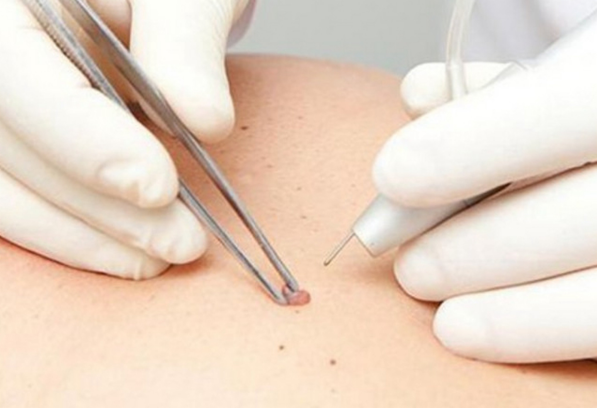 Проведение процедуры.